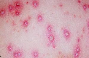 梅毒可以吃瓢瓜吗,瓢瓜的食用建议